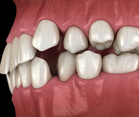 Illustration of gapped teeth