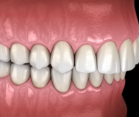 Illustration of an overbite