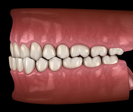 Illustration of an underbite