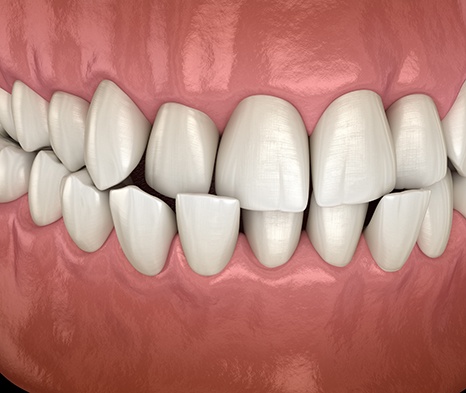 Illustration of a crossbite