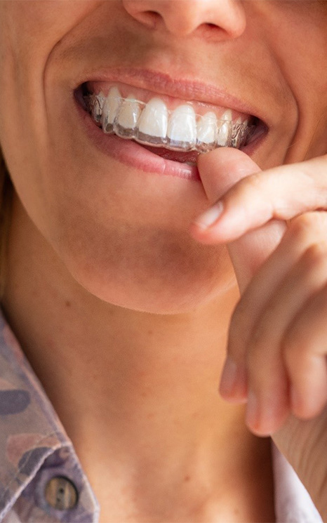 Close up of a person placing a clear aligner over their upper teeth