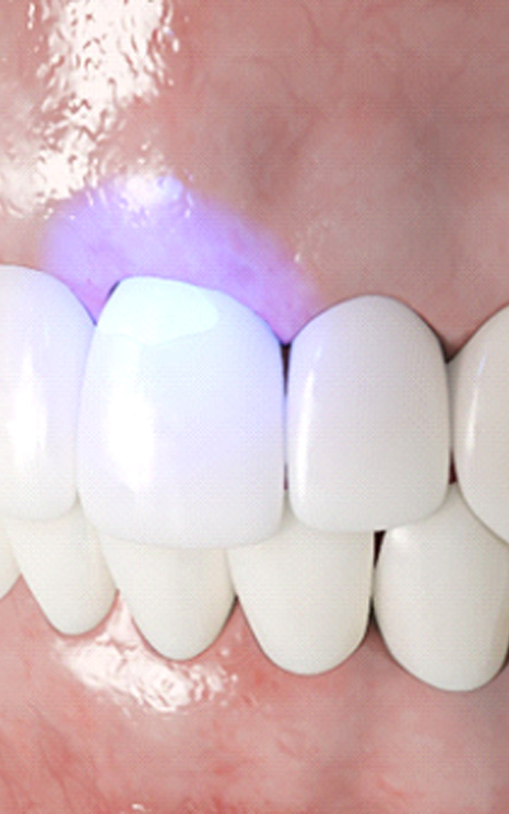 A 3 D illustration of cosmetic dental bonding in Burien