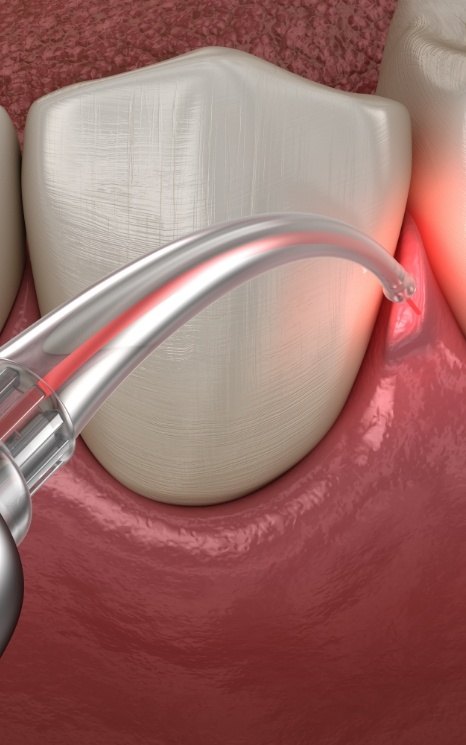 Animated smile during laser periodontal therapy