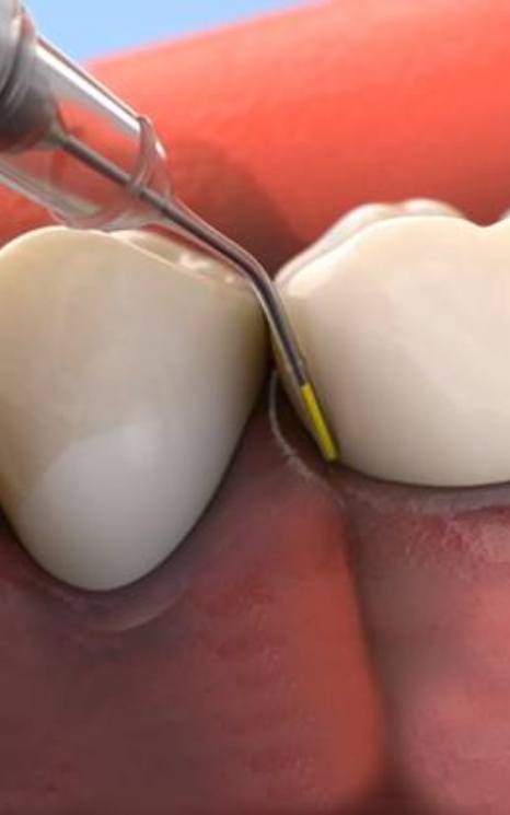 Animated smile during antibiotic therapy