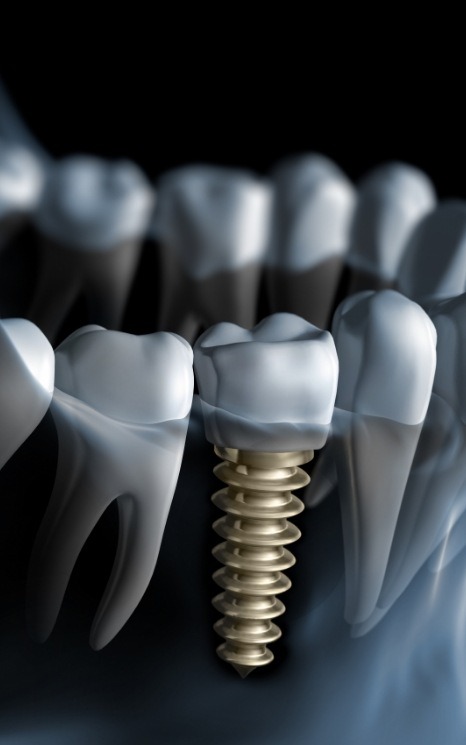 Animated smile with a dental implant in Burien