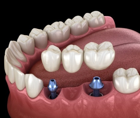 Animated fixed bridge supported by two dental implants