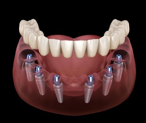 Animated implant denture supported by six dental implants