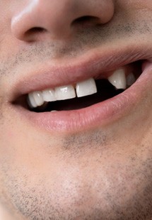 man showing off gap in smile 