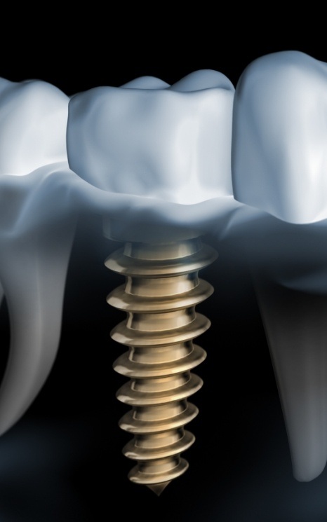 Animated dental implant supported dental crown