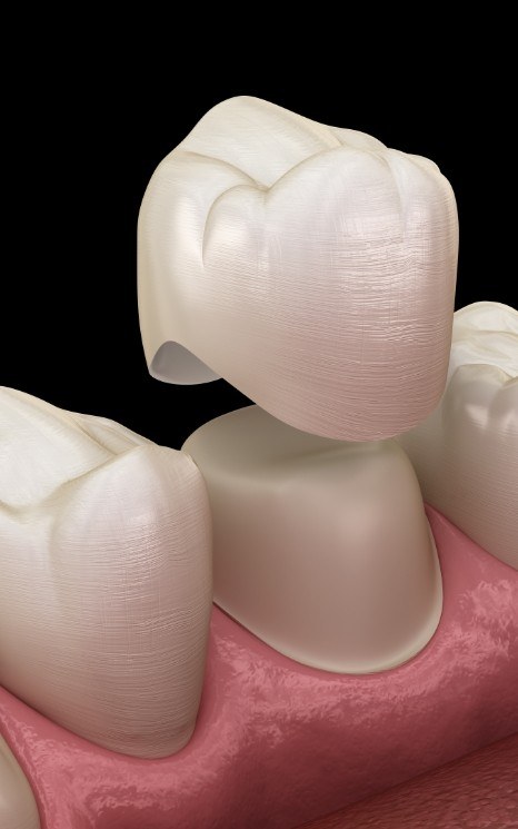 Animated smile during dental crown placement