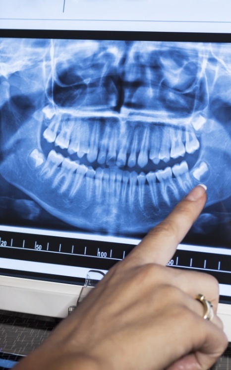 Digital dental x rays on chairside computer