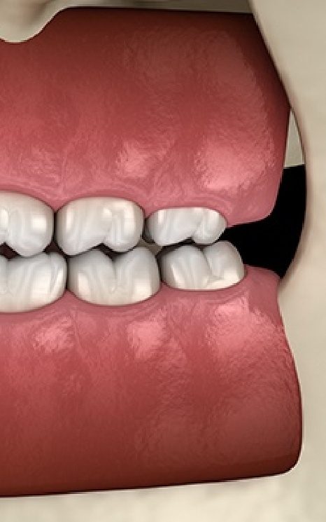 Closeup of animated jaw in need of equilibration and occlusal adjustment