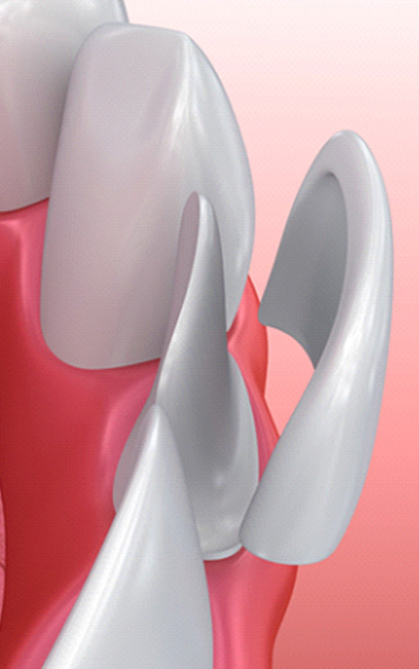 Model of dental veneer in Burien