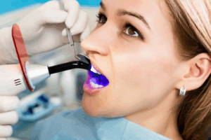 Patient opening wide as dentist whitens her teeth