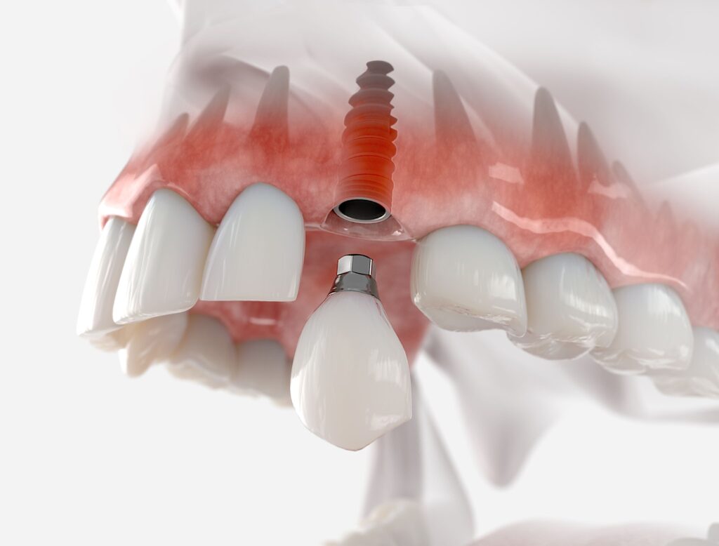 Rendering of dental implant placed in upper arch